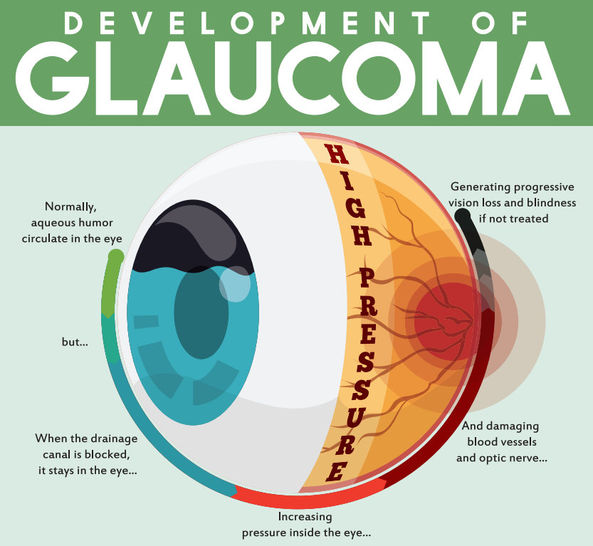 congenital glaucoma diagram